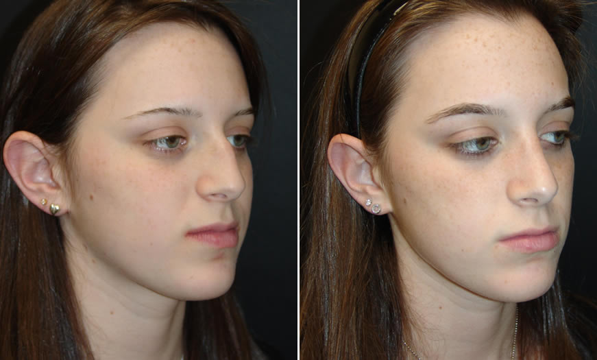 Before & After Rhinoplasty Quarter Right View