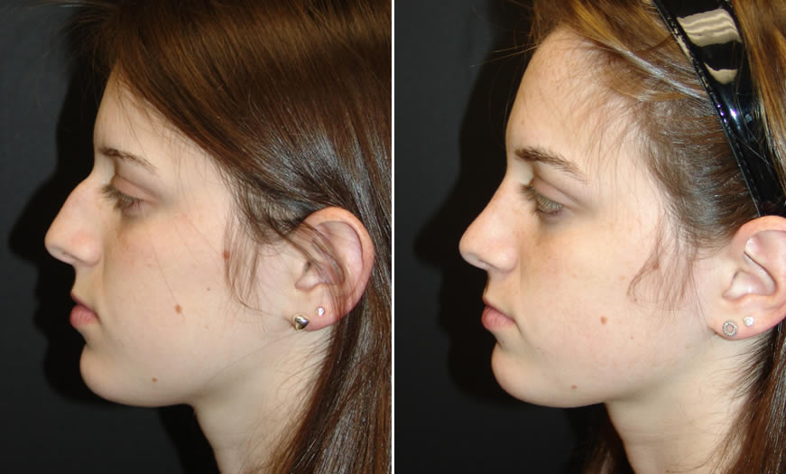 Before & After Rhinoplasty Side Left View