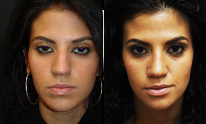 Before & After Rhinoplasty Front View