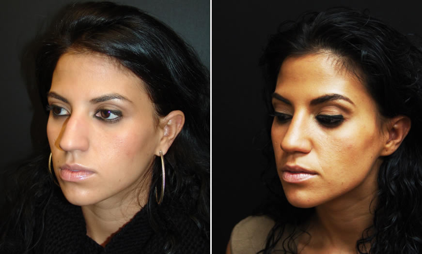 Before & After Rhinoplasty Quarter Left View