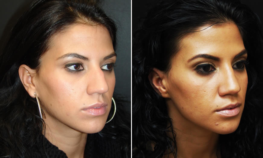 Before & After Rhinoplasty Quarter Right View