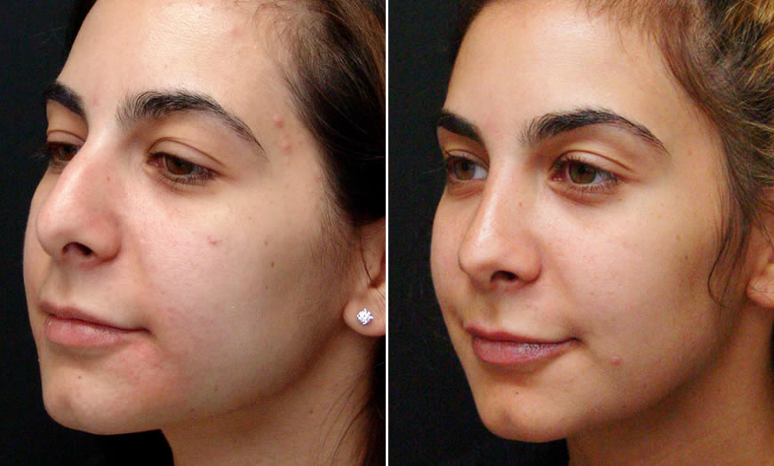 Before & After Rhinoplasty Quarter Left View