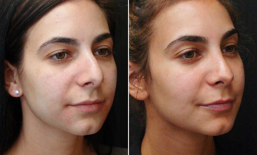 Before & After Rhinoplasty Quarter Right View