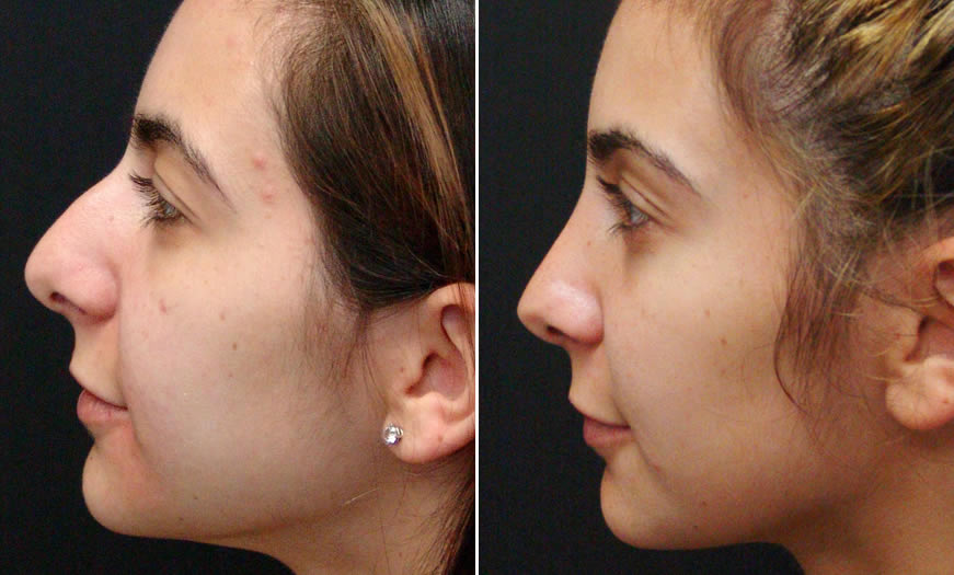 Before & After Rhinoplasty Side Left View