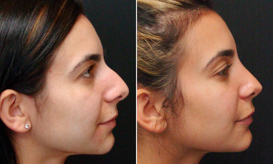 Before & After Rhinoplasty Side Right View