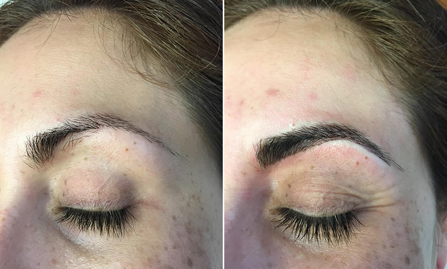 Before & After Microblading Quarter Left View