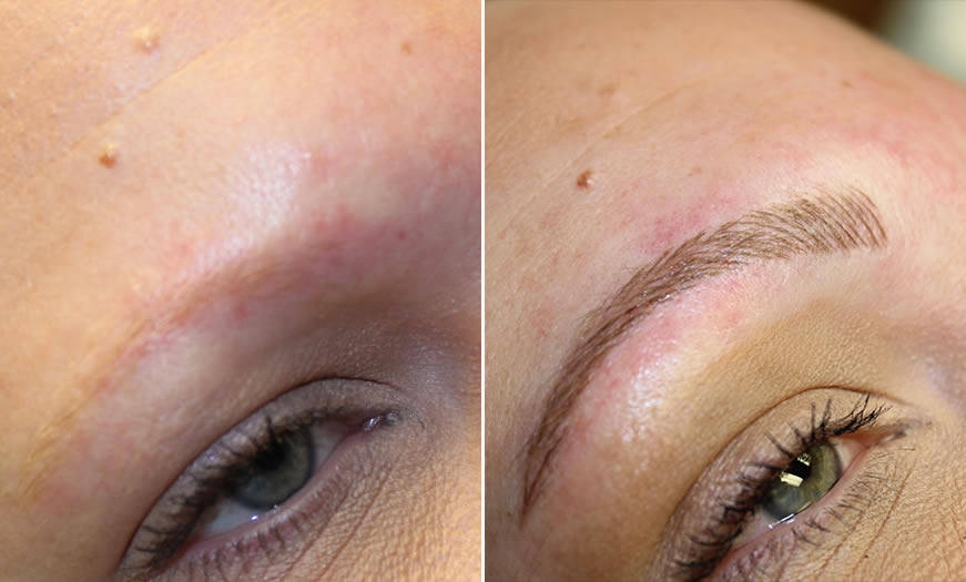 Before & After Microblading Quarter Right View