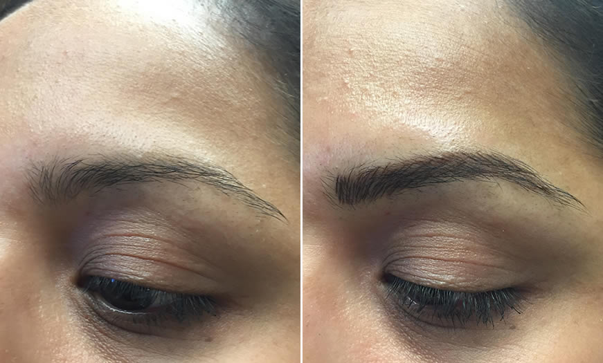 Before & After Microblading Quarter Left View