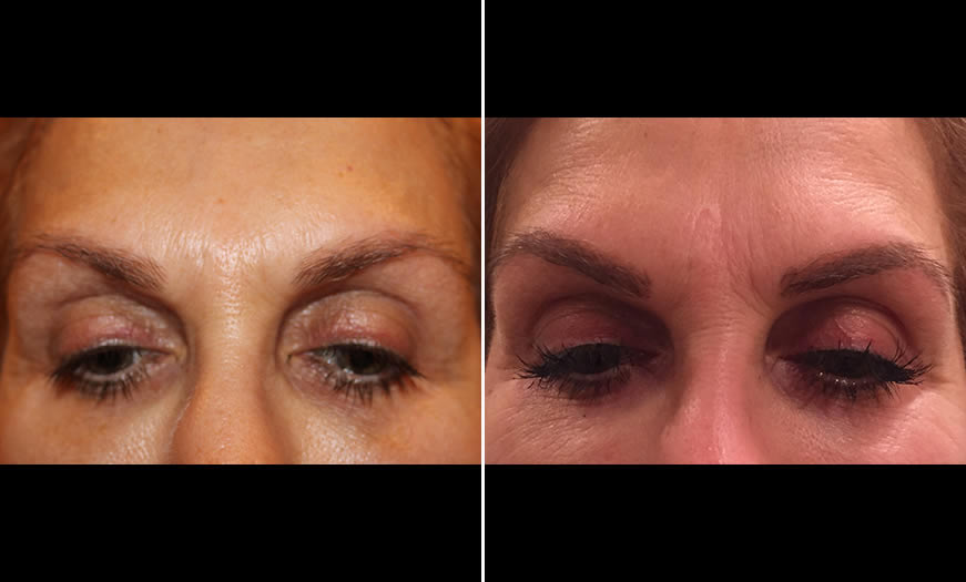 Before & After Microblading Front View