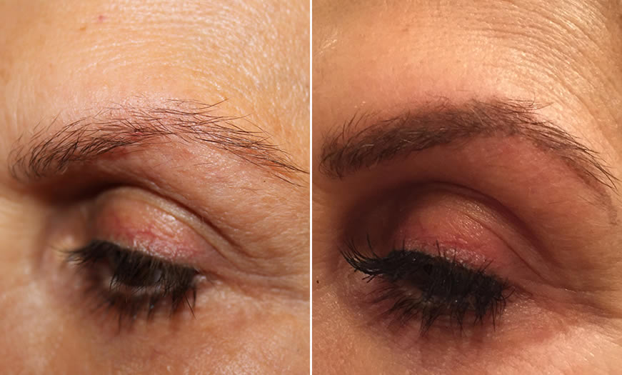 Before & After Microblading Quarter Left View