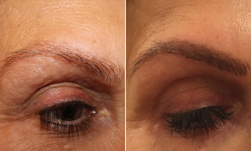 Before & After Microblading Quarter Right View