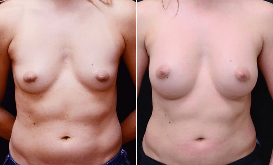 Before & After Combination Procedures Front View