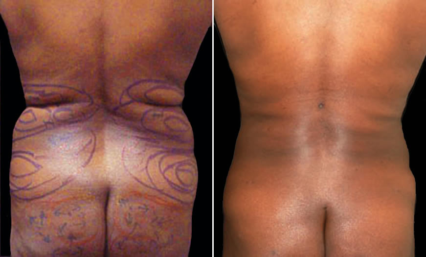 Before & After VASER LipoSelection Back View