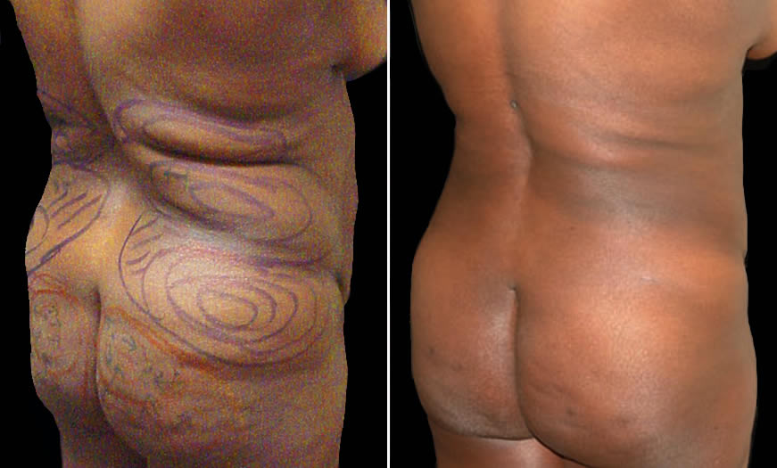 Before & After VASER LipoSelection Quarter Right View