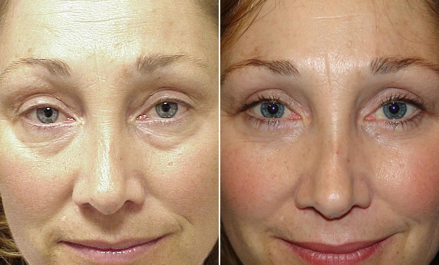 Before & After Blepharoplasty Front View 1