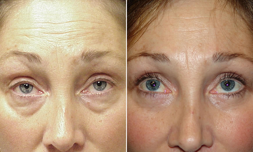 Before & After Blepharoplasty Front View 2