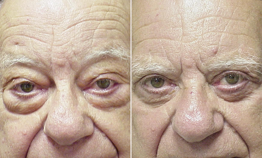 Before & After Blepharoplasty Front View