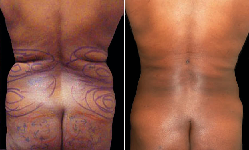 Before & After Combination Procedures Back View