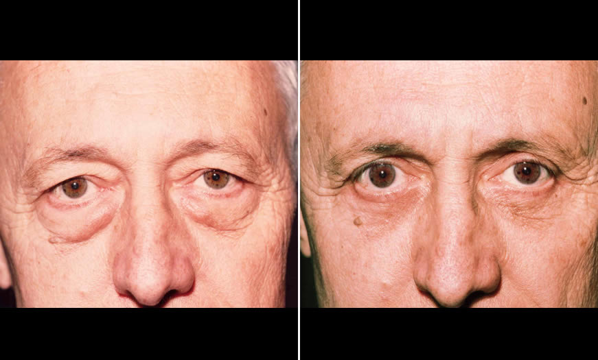 Before & After Blepharoplasty Front View