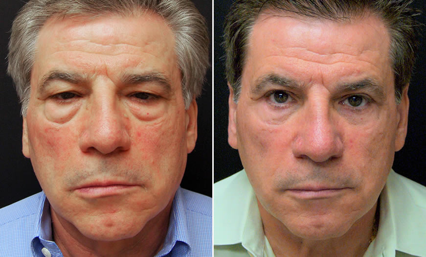 Before & After Blepharoplasty Front View