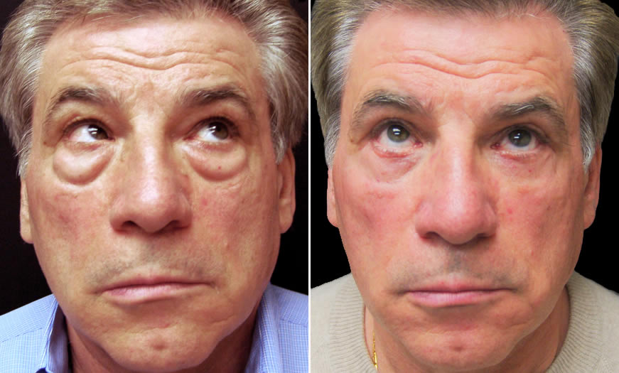 Before & After Blepharoplasty Front View 2