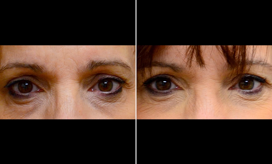 Before & After Cosmetic Fillers Front View 1