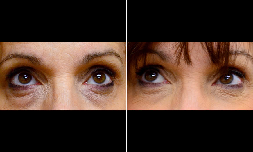 Before & After Cosmetic Fillers Front View 2