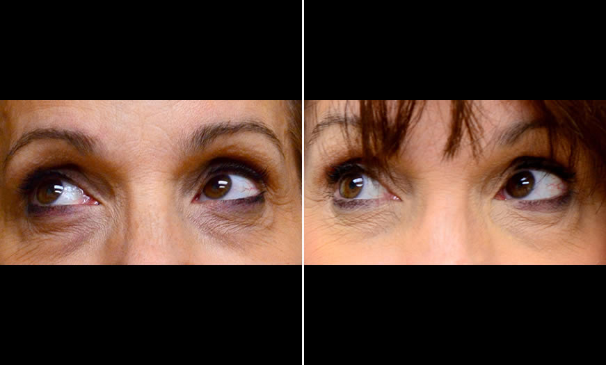 Before & After Cosmetic Fillers Front View 3