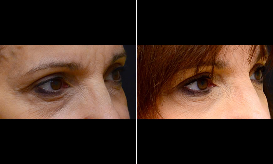 Before & After Cosmetic Fillers Quarter Right View