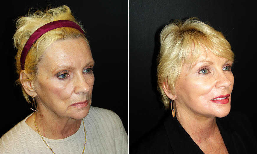 Facelift Before & After quarter Right