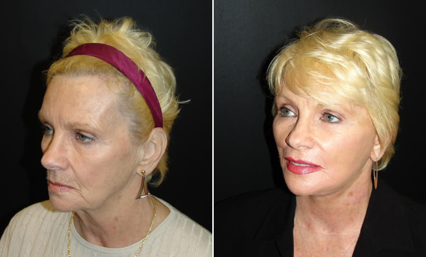 Facelift Before & After quarter left