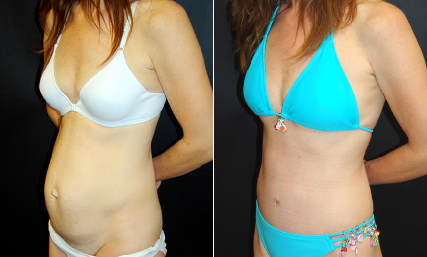 Before & After Tummy Tuck Quarter Left View