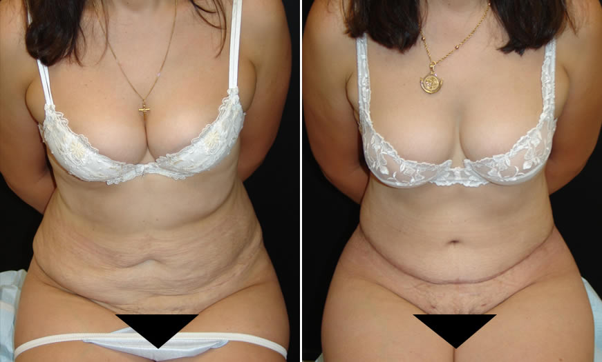 Before & After Tummy Tuck Front Sitting View