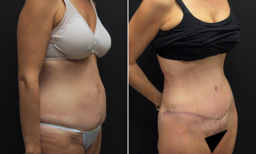 Before & After Core Abdominoplasty Quarter View Right