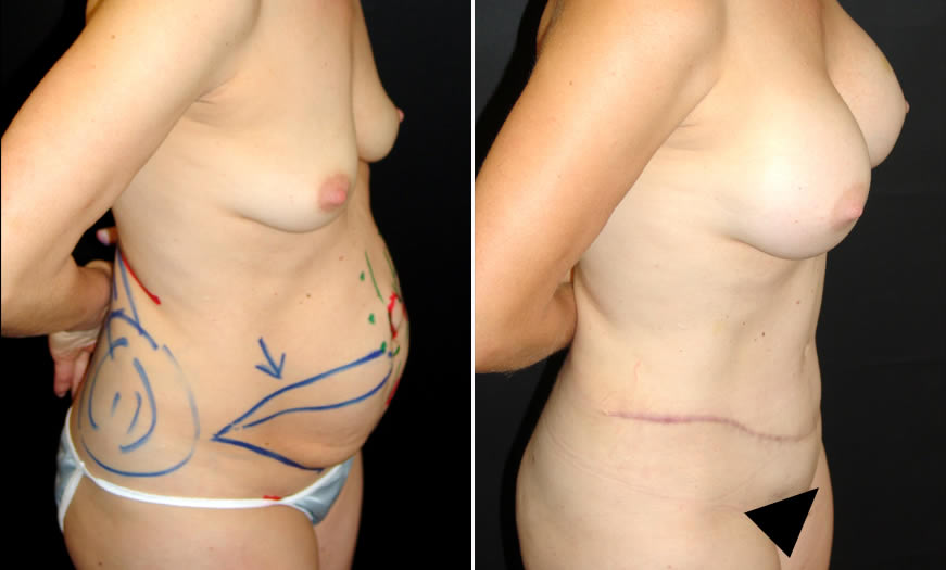 Core Abdominoplasty Before & After Side View Right