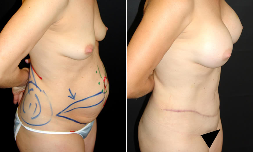 Tummy Tuck Before & After Side Right View 