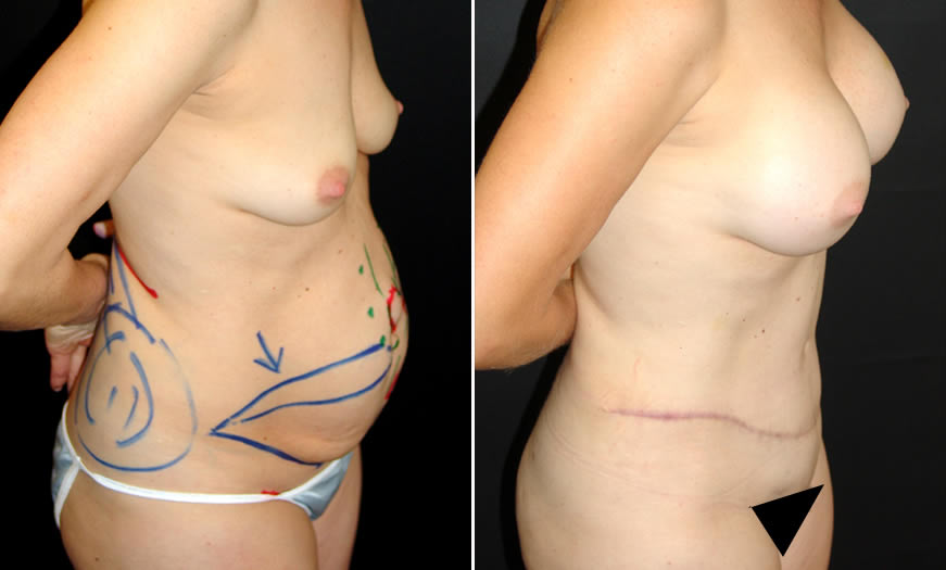 Before & After Combination Procedures Side Right View