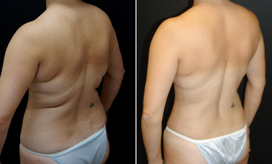 Before & After Breast Reduction Back Quarter Left View