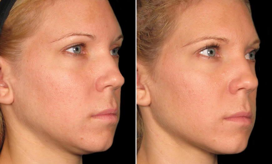 Before & After Ultherapy Side right View