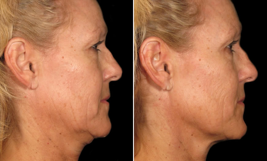 Before & After Ultherapy Side right View