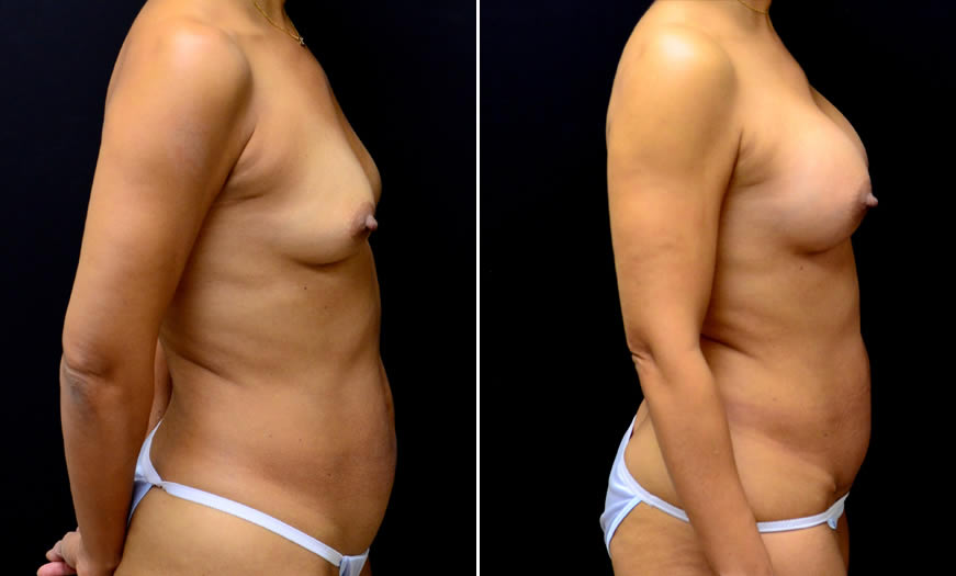 Breast Augmentation Side View Right