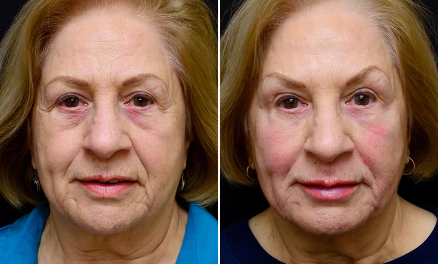 Before & After Cosmetic Fillers Front View 1