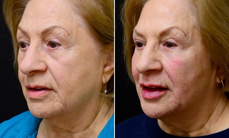 Before & After Cosmetic Fillers Quarter Left View