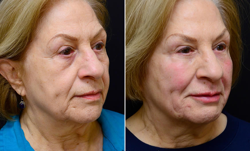 Before & After Cosmetic Fillers Quarter Right View