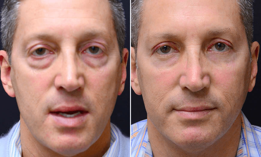 Before & After Blepharoplasty Front View 1