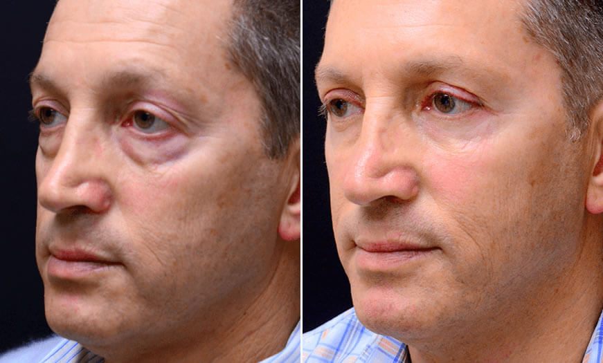Before & After Blepharoplasty Quarter Left View