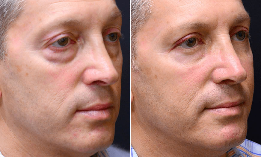 Before & After Blepharoplasty Quarter Right View