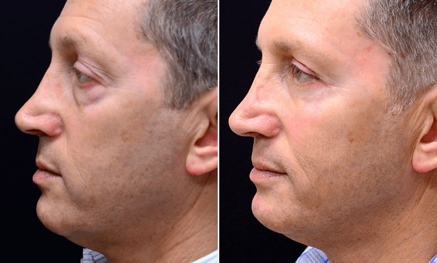 Before & After Blepharoplasty Side Left View