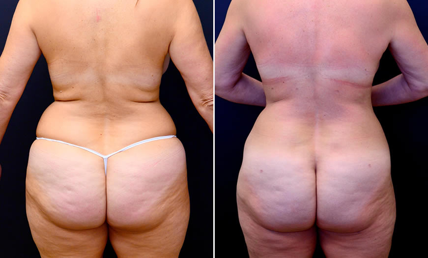 Before & After Liposuction Back View