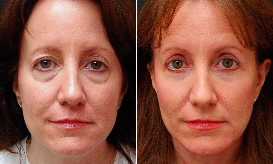 Before & After Blepharoplasty Front View